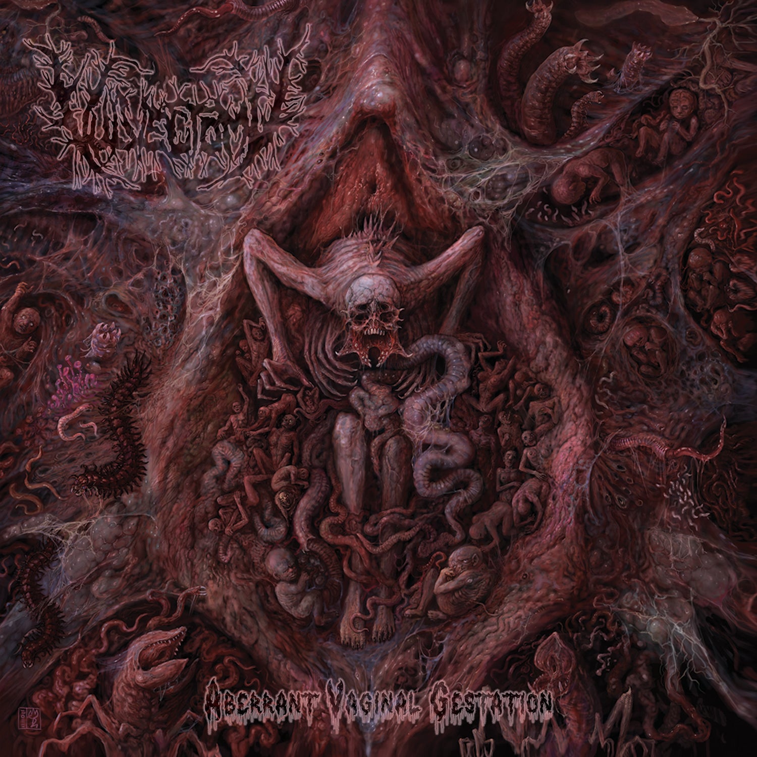 Vulvectomy - Aberrant Vaginal Gestation (CD)