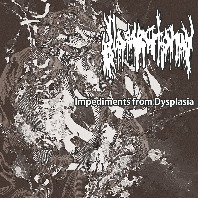 Glossectomy - Impediments From Dysplasia (CD)