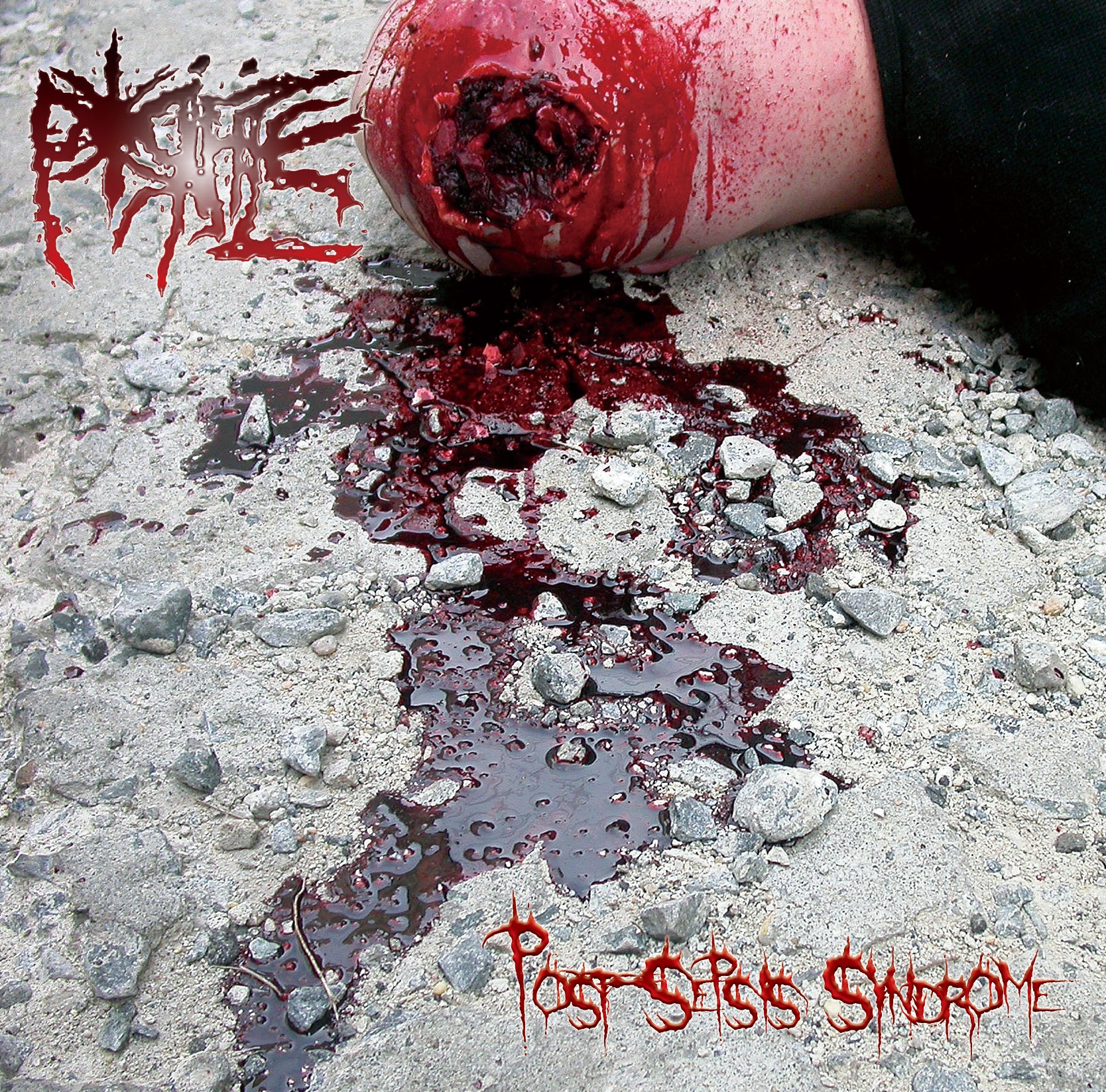 Porifice - Post​-​sepsis Syndrome (CD)