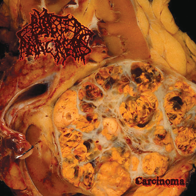 Blasted Pancreas - Carcinoma (LP)